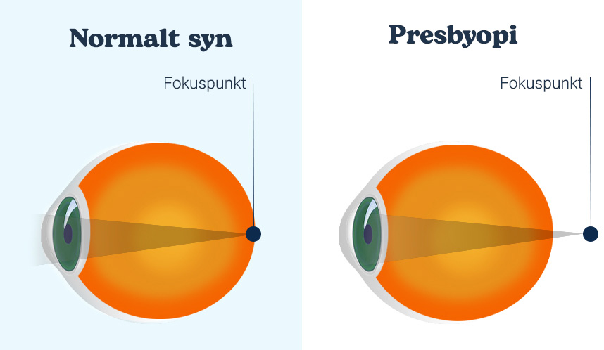 billede af fokuspunkt i normalt øje og i øje med presbyopi