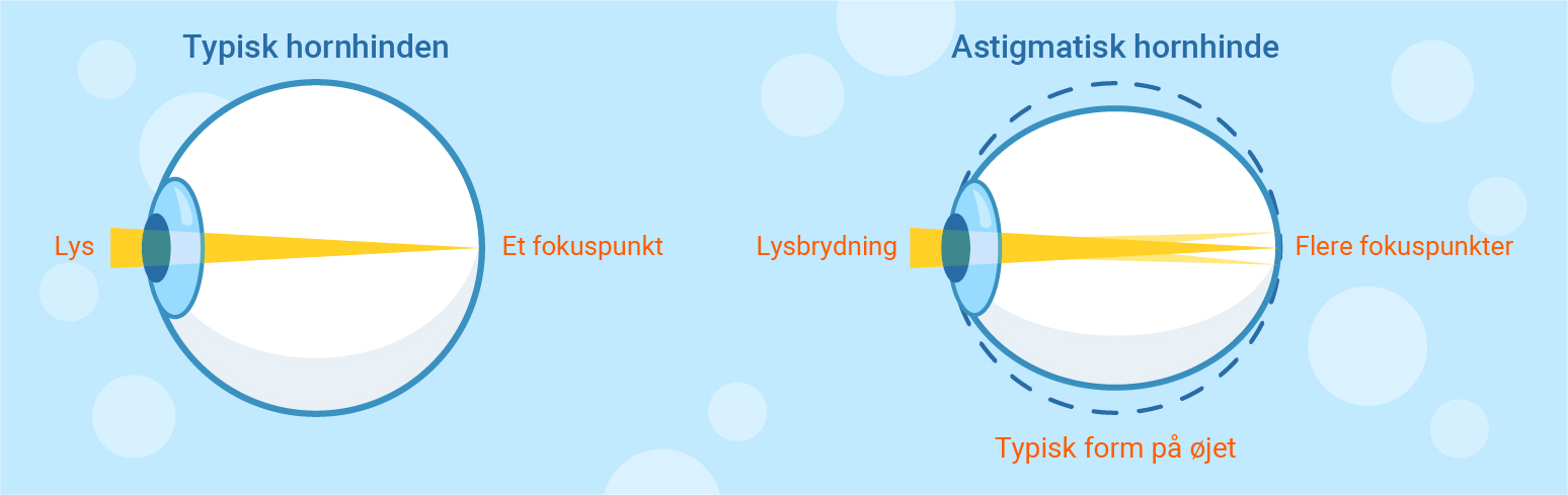 typical and astigmatism cornea